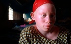 Pour être élu, le candidat à la présidentielle 2012 débourse dix millions pour un litre de sang d'un albinos