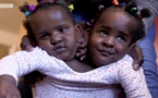 VIDEO - Ndèye et Marième, des jumelles siamoises qui luttent pour leur vie