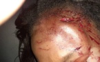 Images choquantes: Voici la sage-femme agressée par un Kankourang à Sédhiou