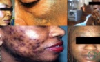 Dépigmentation au Sénégal: Les chiffres effroyables du phénomène