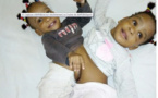 Cameroun : deux petites sœurs siamoises opérées avec succès en France