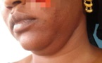 Photo:Sa coépouse lui arrache une partie de la joue avec ses dents