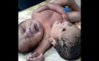Inde: Une femme donne naissance à des «jumeaux siamois rares»