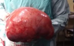 Photos: un fibrome de dix kilogrammes retiré d'une dame à Thiès