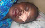 Guédiawaye: Ivre mort, un homme défigure le visage de sa femme (photo)