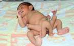 Le bébé né avec six jambes opéré avec succès