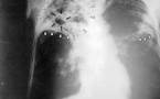Sénégal-réduction drastique du nombre de décès dû à la tuberculose : Plan Sénégal en appoint aux structures sanitaires du pays