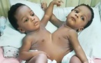 Des médecins nigérians séparent des siamoises