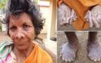 Inde: Découverte d’une femme avec 31 doigts et orteils 