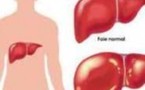 Traitement des hépatites virales : Essayez le Terminalia catappa, le Tinospora, le Tamarindus…