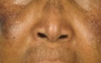 Dépigmentation : Des hommes sont entrés dans la danse