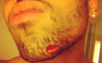 Photo : Chris Brown le menton en sang après une bagarre