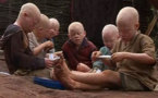 Plainte: Les Albinos veulent traduire en justice les criminels 
