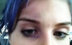 Photo : Kelly Osbourne et son oeil au beurre noir