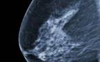 Cancer du sein : 75% des cas détectés tardivement