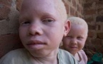 Quand les Albinos du Sénégal se fâchent