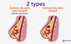 VIDEO - "Il y'a différents types de cancer du sein, chaque femme doit s'autopalper pour...."