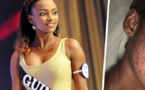 Victime d’une réaction allergique causée par des produits de beauté, la Miss Cedeao 2012 méconnaissable (Photos)