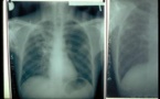 Tuberculose: 12810 cas enregistrés en 2012, soit une augmentation de 1200 cas
