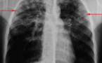 LA TUBERCULOSE AU SENEGAL :  Dakar l’épicentre de l’infection