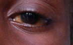 Covid-19 et épidémie de conjonctivite: Les éclairages du Pr. Pape Ndiaye, ophtalmologue
