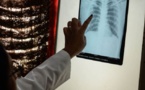 Tuberculose: Diourbel est la deuxième région la plus touchée du Sénégal
