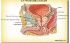 795 femmes meurent du cancer de l’utérus par an au Sénégal