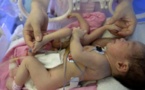(Photo) Un bébé naît avec quatre jambes et quatre bras. Regardez