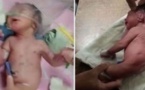 Un bébé né avec une corne étrange au lieu de jambes, laisse les médecins perplexes