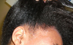Alopécie ou chute de cheveux : traitements naturels