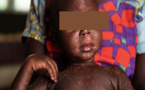 Santé : Un cas de rougeole détecté à Bignona 