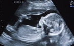 Des "fœtus" jumeaux découverts à l'intérieur d'un nouveau-né