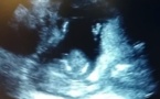 L'incroyable vidéo d'un bébé qui applaudit pendant l'échographie
