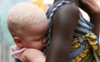 Au Malawi : un instituteur arrêté pour avoir tenté de vendre sa petite amie albinos