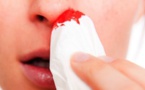 Astuces pour arrêter le saignement de nez