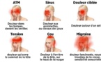 Apprenez à reconnaître les maux de tête dangereux