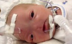 Eli, le bébé qui est né sans nez, il continue de se battre pour vivre (photos)