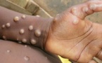 Mpox : L'OMS prolonge son niveau d'alerte maximale