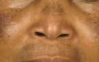 Dépigmentation volontaire des femmes : Une mort à petit feu !