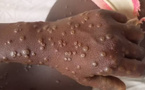 Alerte Santé : Le Sénégal enregistre un deuxième cas positif de la maladie Mpox
