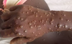 Santé-Alerte Mpox : quatre cas confirmés, 38 personnes sous surveillance