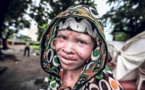 Guinée : le Président Alpha Condé préoccupé par la vulnérabilité des albinos