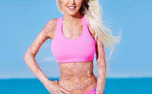 Une Australienne de 25 ans brûlée vive donne une belle leçon de vie