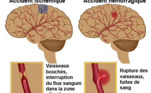 Voici comment sauver une personne d’un AVC en utilisant juste une Aiguille