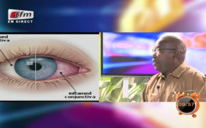 Vidéo:Astuce Santé:La maladie des yeux “Apolo” ou conjonctivite:les types de traitement