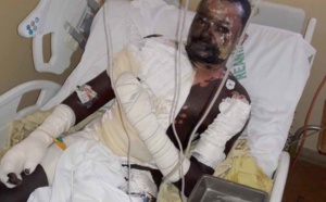Sa femme lui verse de l'huile chaude et s'enfuit, Babacar Mbaye entre la vie et la mort (images)