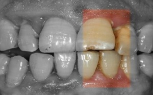 Santé: Découvrez la gingivite la maladie qui détruit silencieusement la bouche