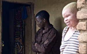Témoignages- Martha, albinos au Malawi: « J’ai dû me cacher durant neuf jours à cause des tueurs »