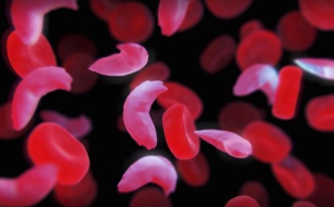 Drépanocytose: première guérison par thérapie génique