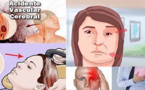 10 symptômes inquiétants qui indiquent qu’un AVC est proche !